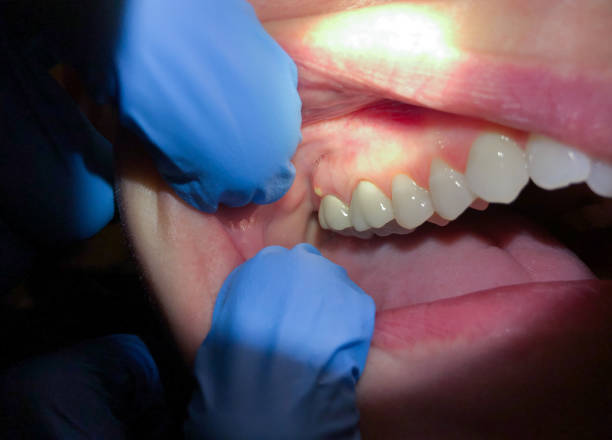 Best Broken or Cracked Tooth Emergency Dentist in Surgoinsville, TN