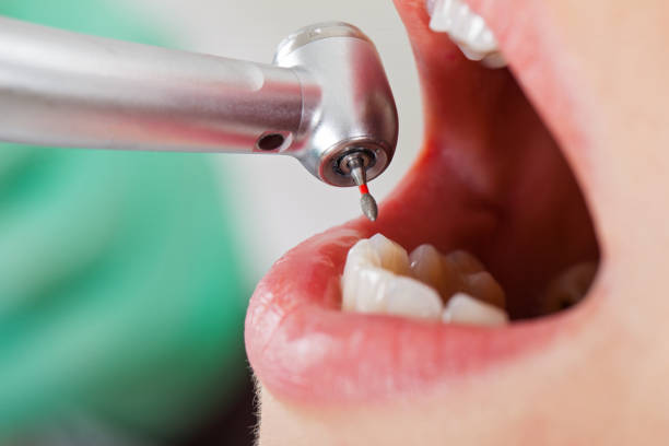 Best Emergency Dental Care for Abscessed Tooth in Surgoinsville, TN